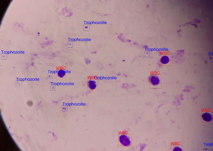he image displayed represents a blood sample. Using this data, an AI model is trained to accurately detect and identify trophozoites and white blood cells through the use of bounding boxes.